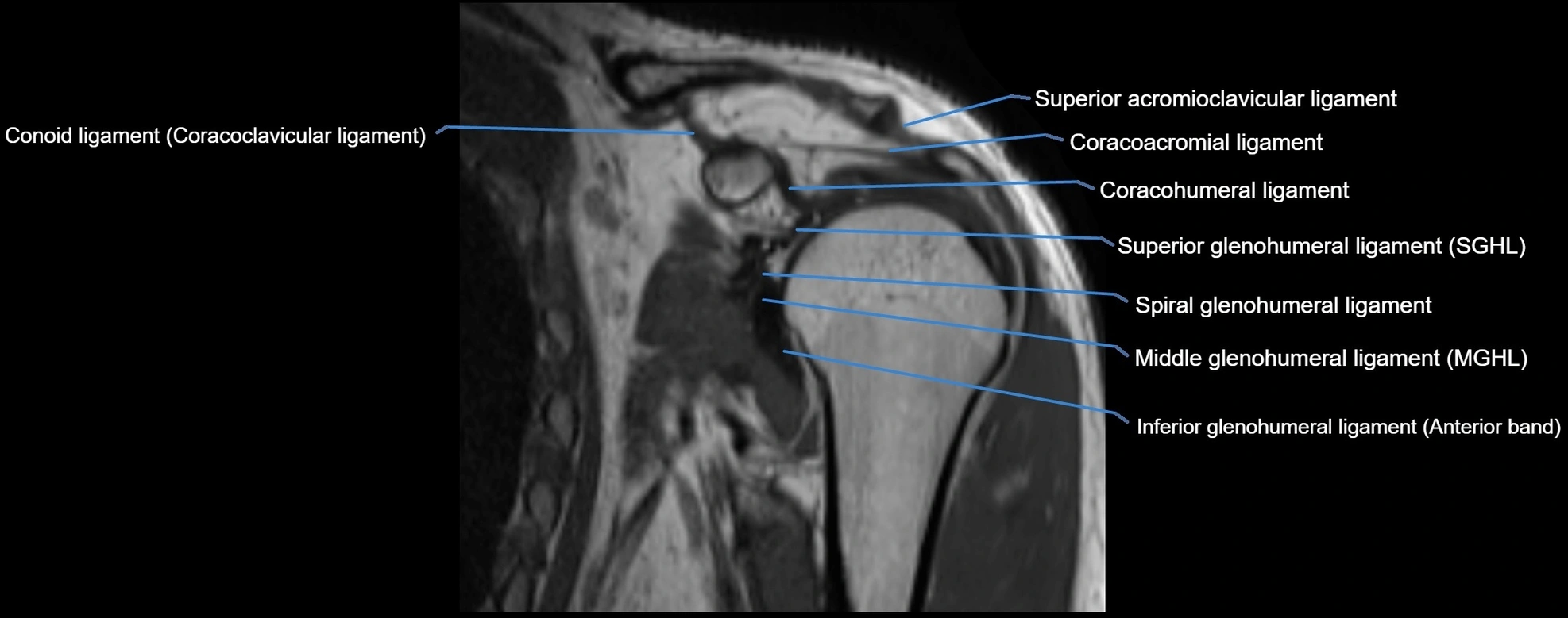 shoulder ligments coronal  cross sectional anatomy 3T MRI AI enhanced radiology image -img-00001-00017.webp
